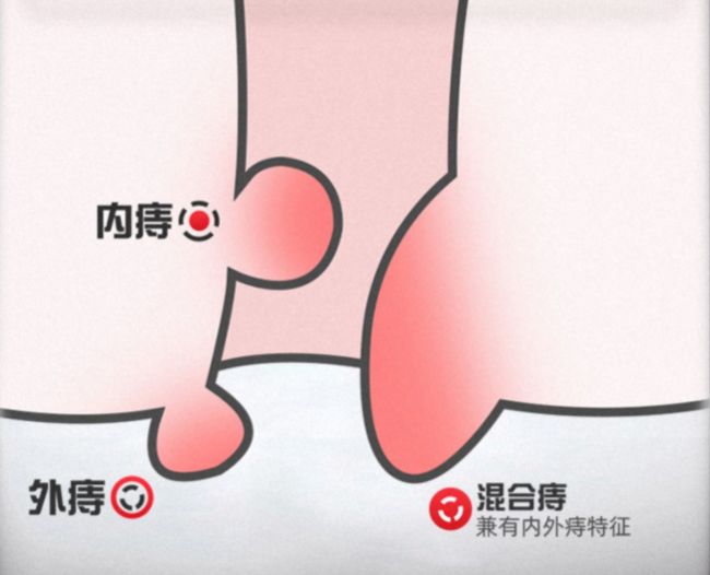 贴肚脐,1-2贴解除轻度痔疮:一盒4贴 荣昌肛泰 痔疮贴肚脐贴